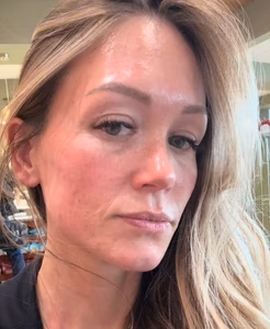 Skin showing redness and minor blemishes before using Heartleaf products