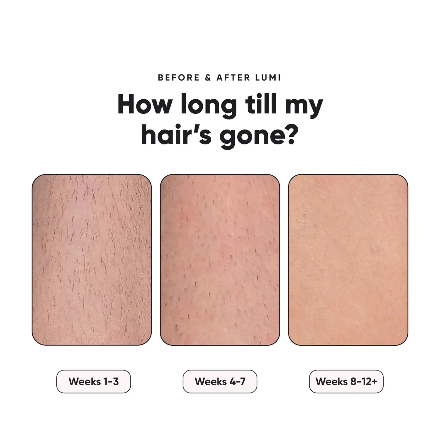 صورة بعد استخدام جهاز إزالة الشعر