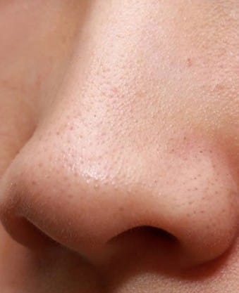 Dull skin before using the scrubber