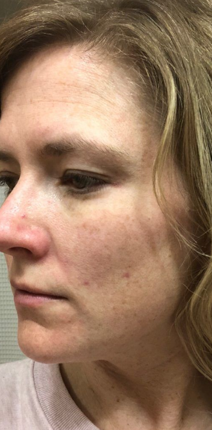 Uneven skin tone before applying Beauty of Joseon Toner