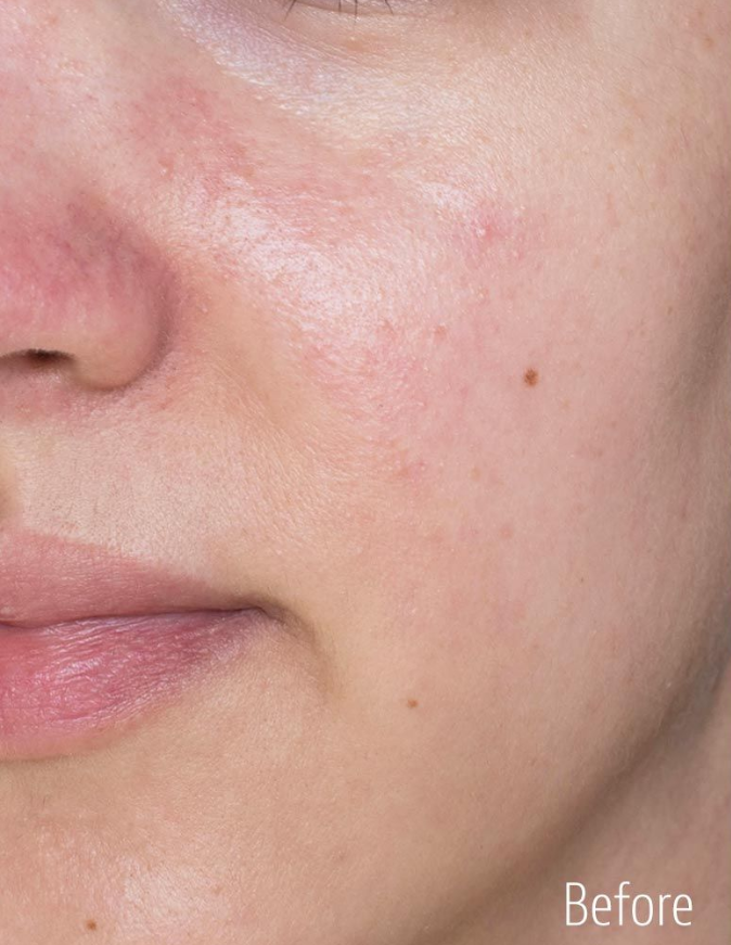 Clogged pores before applying Red Bean Pore Mask