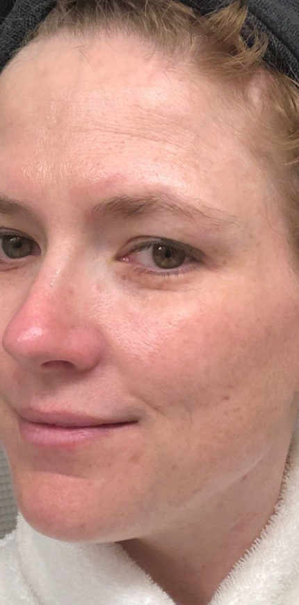 Glowing complexion post Beauty of Joseon Toner application