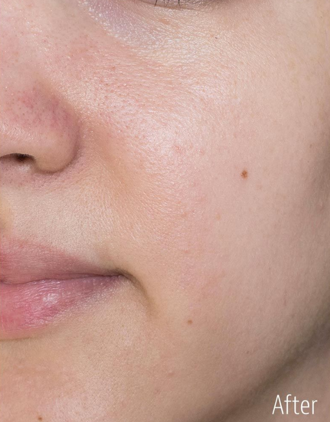 Refreshed pores after using Red Bean Pore Mask