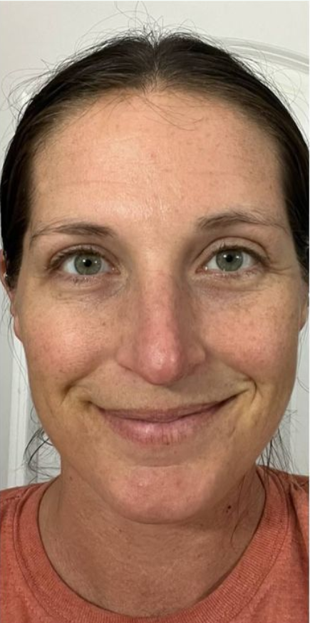 Dull skin before using Beauty of Joseon Green Plum Cleanser