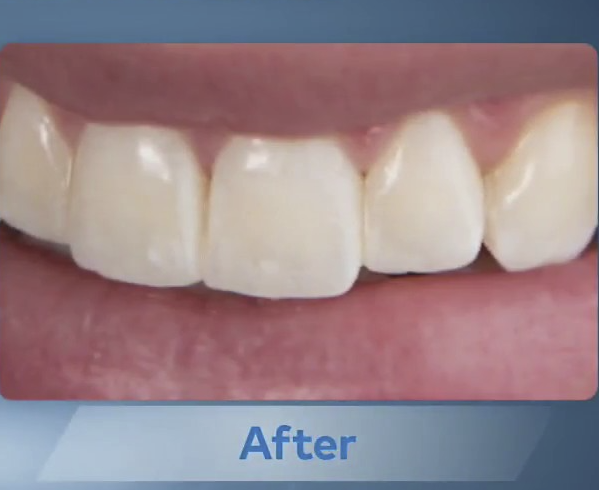 Image showing a clean, healthy smile after using Waterpik