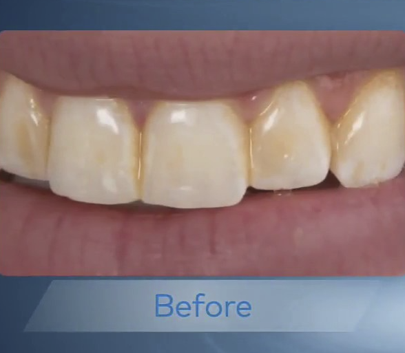 Image showing plaque buildup before using Waterpik