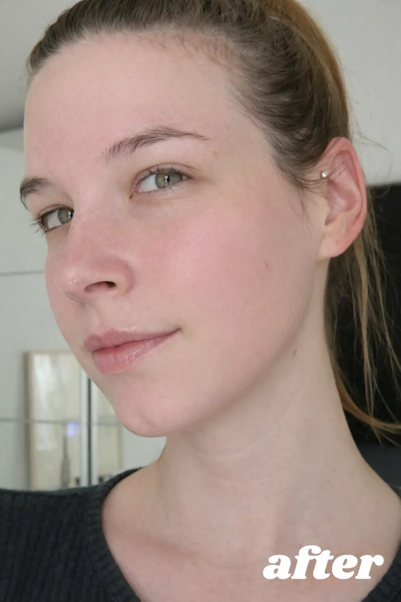 Improved skin condition after five weeks using Glowvyn