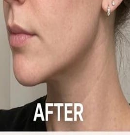 After using RAFSKINTECH™ ContourLift Pro for a sculpted jawline