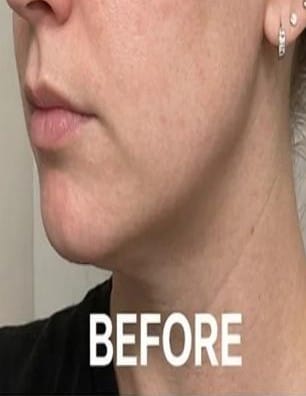 Before using RAFSKINTECH™ ContourLift Pro with visible puffiness