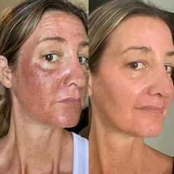 Before and after comparison of eye area using Dr. Melaxin Collagen Boost Set