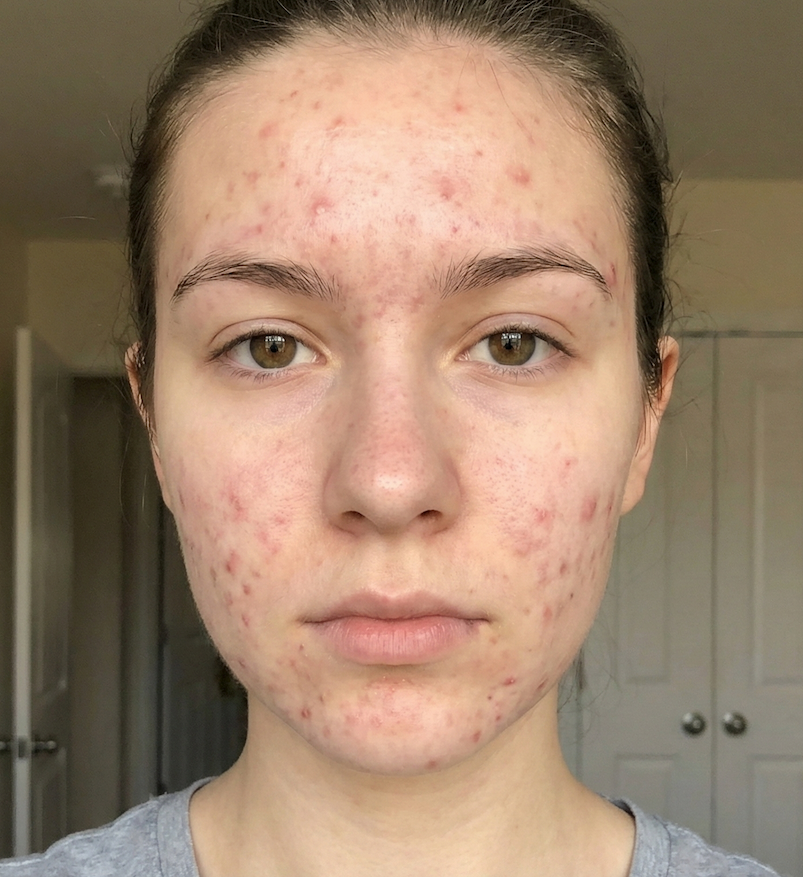 Uneven skin tone before using Dr. Melaxin Collagen Boost Set