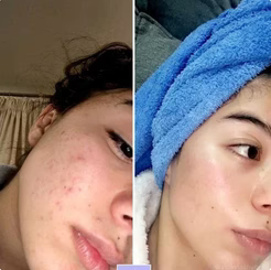 A happy customer showcasing radiant skin after using Dr. Melaxin Collagen Boost Set
