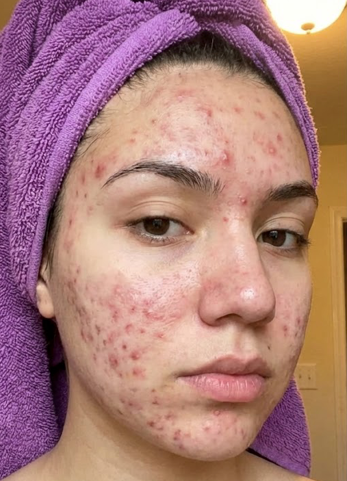 Loose skin before using Dr. Melaxin Collagen Boost Set