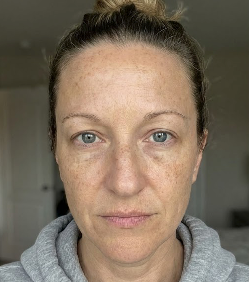 Dry skin before using Dr. Melaxin Collagen Boost Set