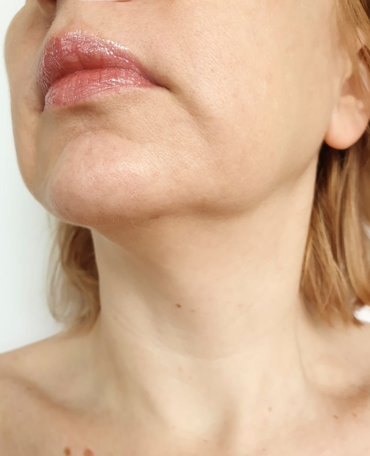 Uneven skin texture and tone before using the comprehensive skincare set.