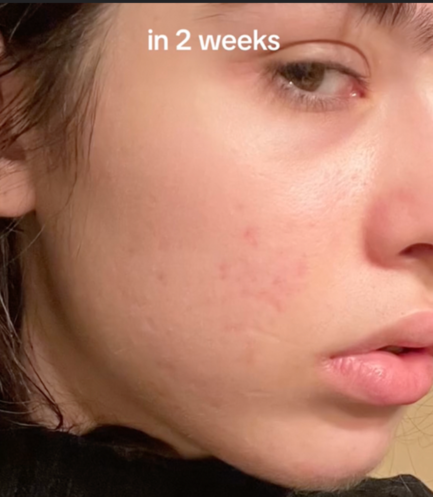 صورة توضح تأثير الواقي الشمسي في حماية البشرة