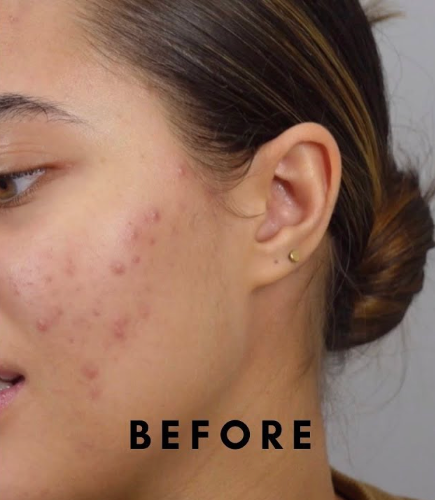 صورة توضح البشرة قبل استخدام مجموعة العناية الكاملة