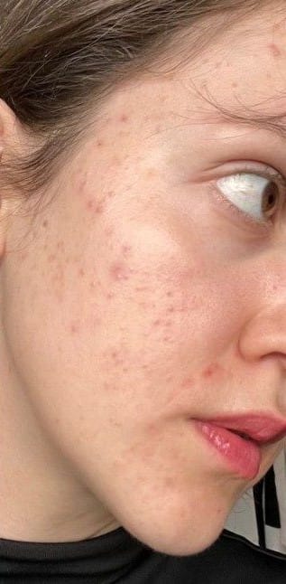 Radiant skin after using Vegan Kombucha Skincare