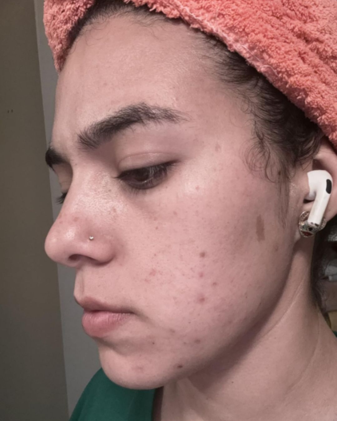 Woman with slightly irritated or dry skin before using the SKIN1004 Madagascar Centella Travel Kit.