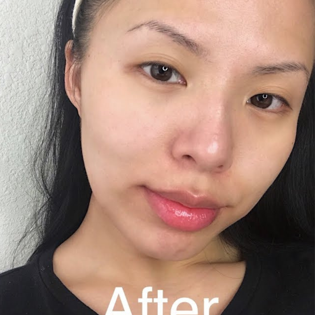 Refined pores after applying Medicube Zero Pore Pad
