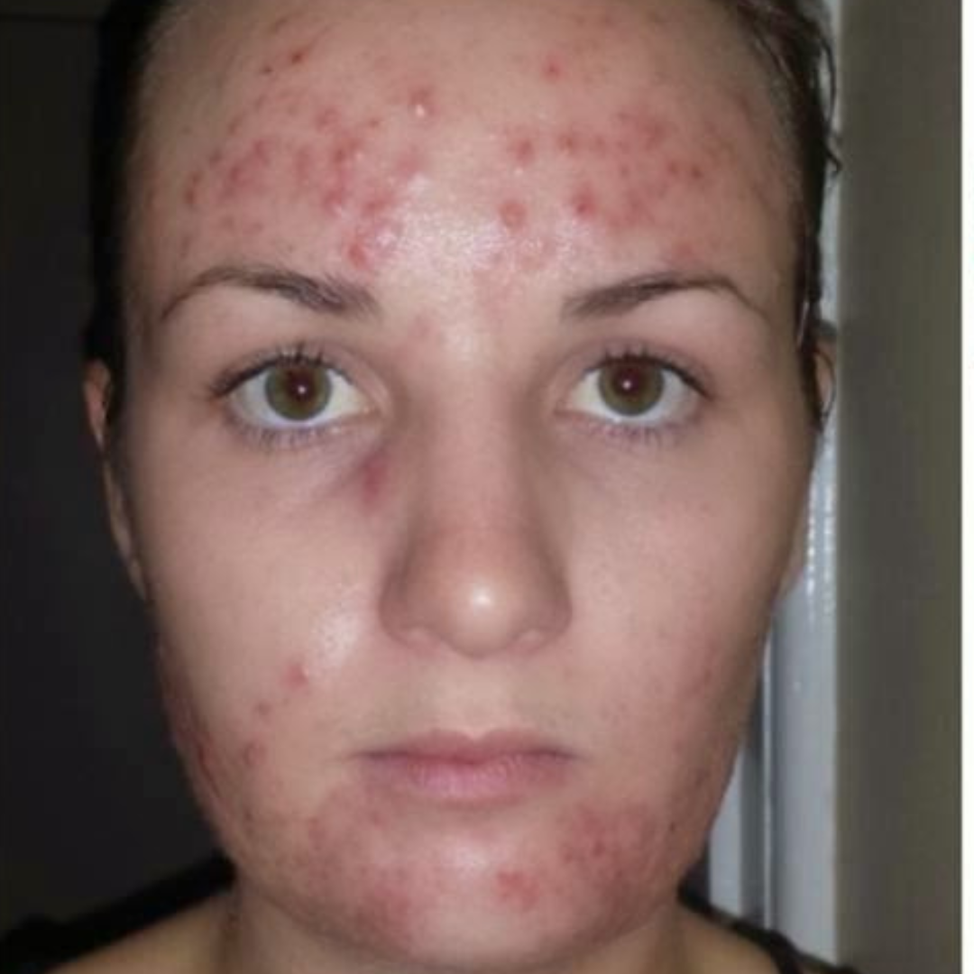 Uneven skin tone before Medicube PDRN Pink Collagen Gel Mask