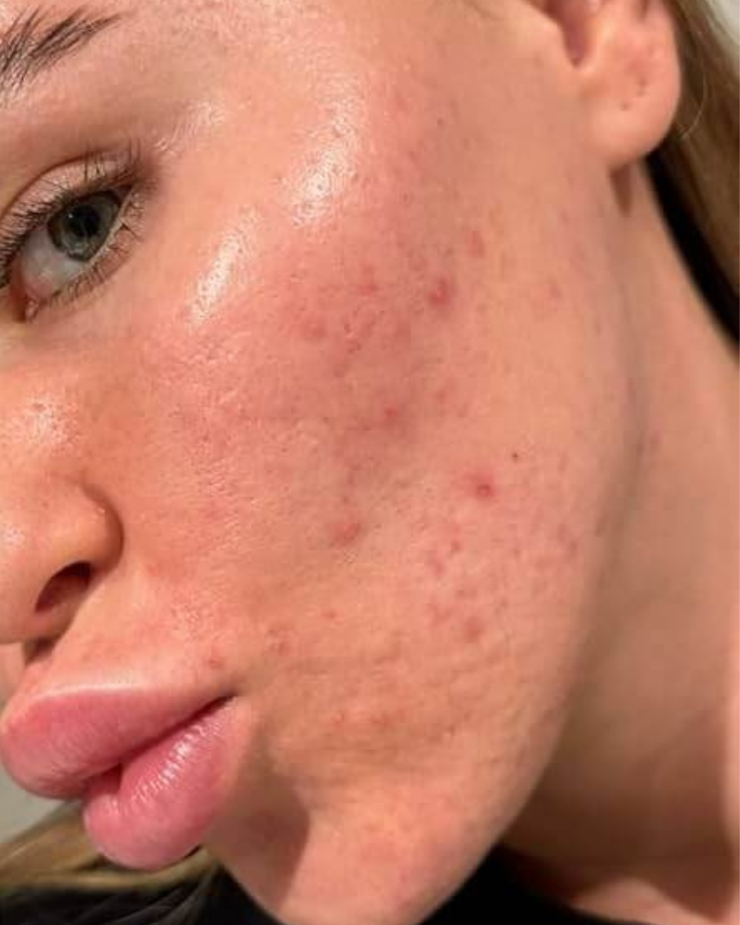 Woman with visibly improved skin after using the LED facial mask