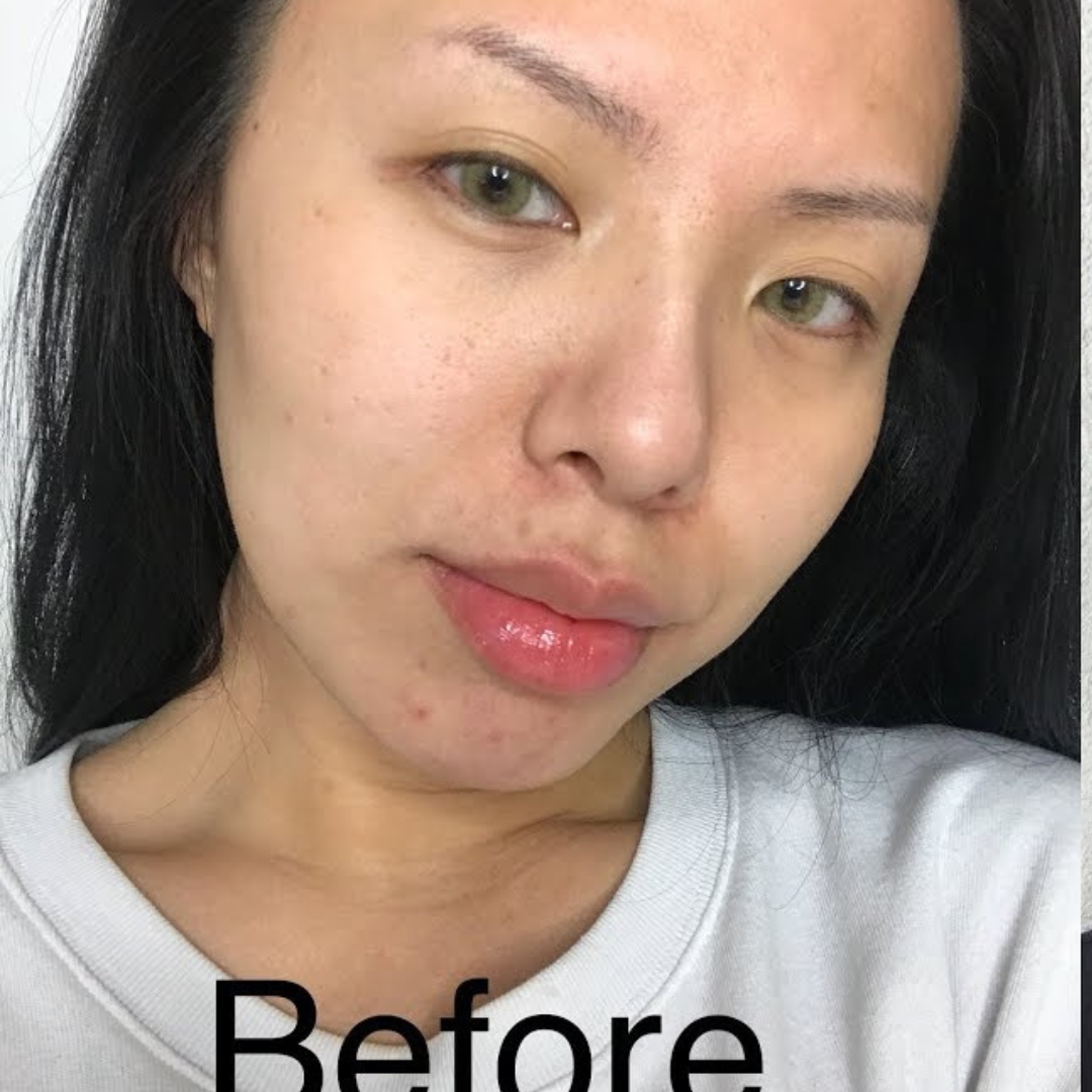 Enlarged pores before using Medicube Zero Pore Pad