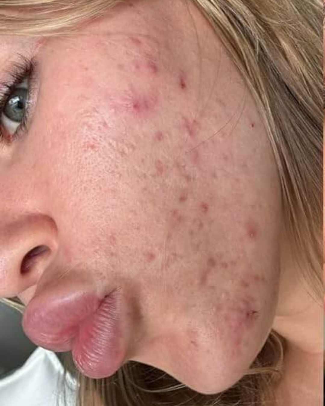 Woman with acne, wrinkles, and dull skin before using the LED facial mask