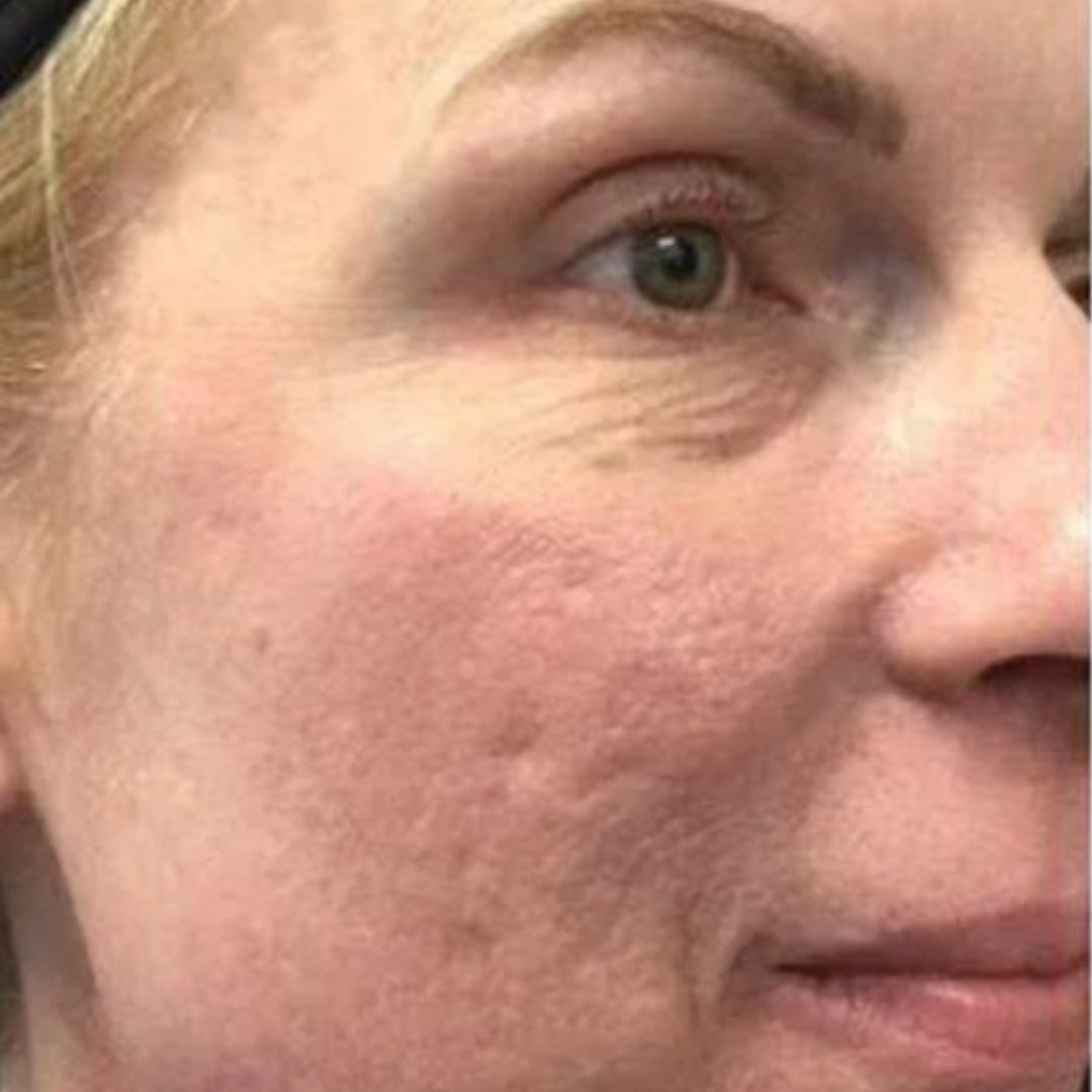 Skin before cleansing with Medicube Zero Foam Cleanser