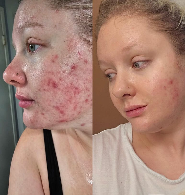Man with reduced acne and smoother skin