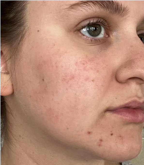 Dull skin before using L'Oreal Revitalift Glass Skin Hydrogel Glow Mask