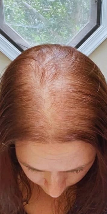 Thin hair before treatment