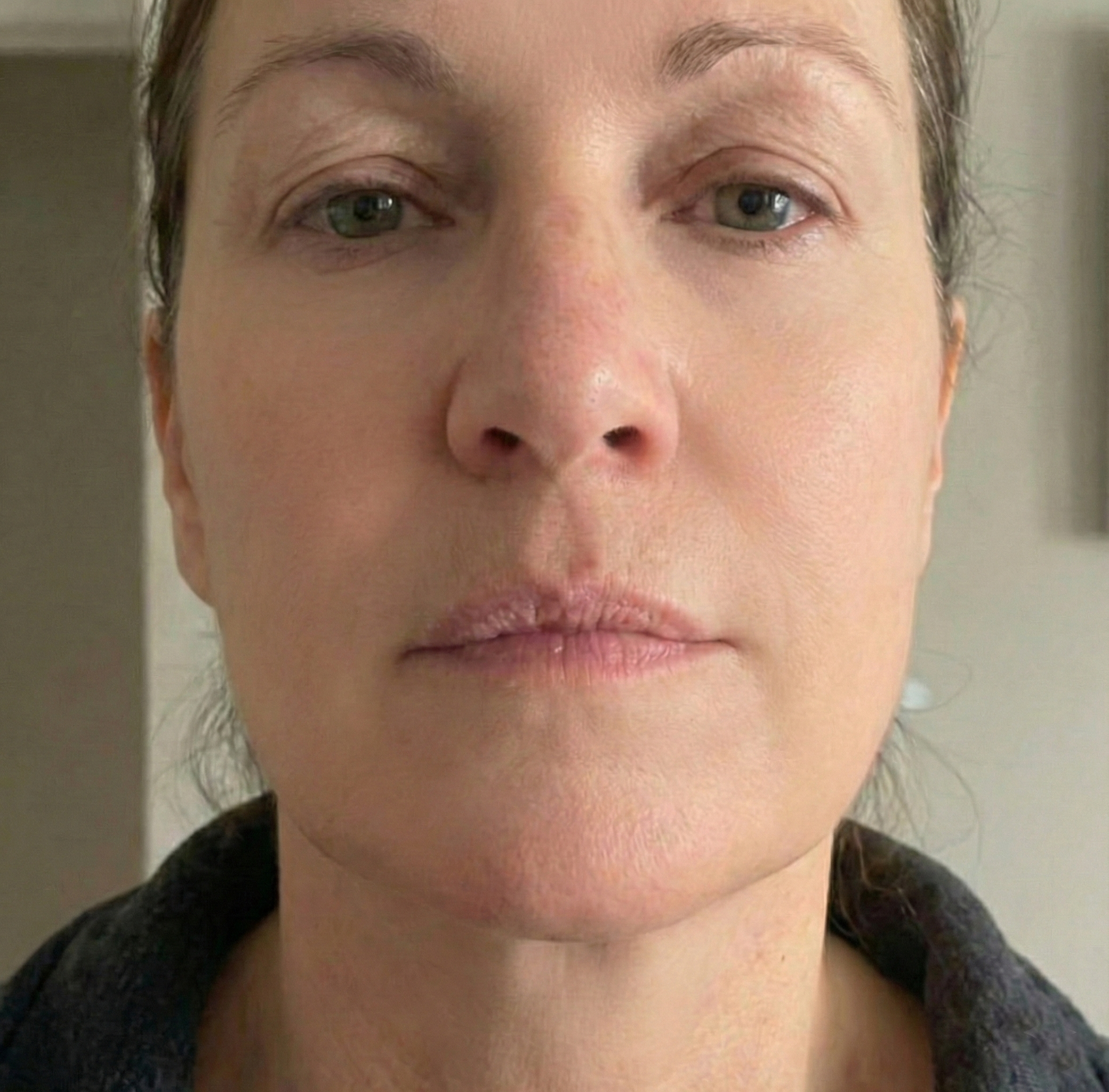 Resultaat na gebruik van het LED-masker