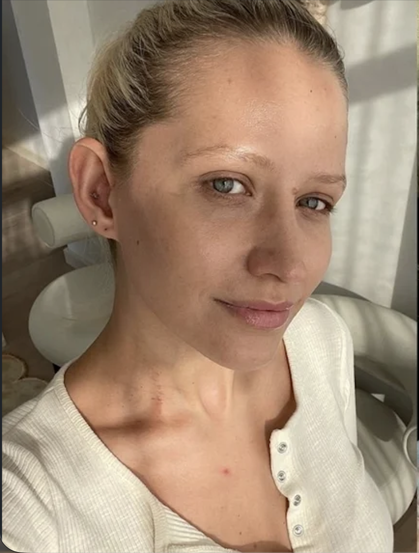 Puffy skin before using silicone ice bath bowl