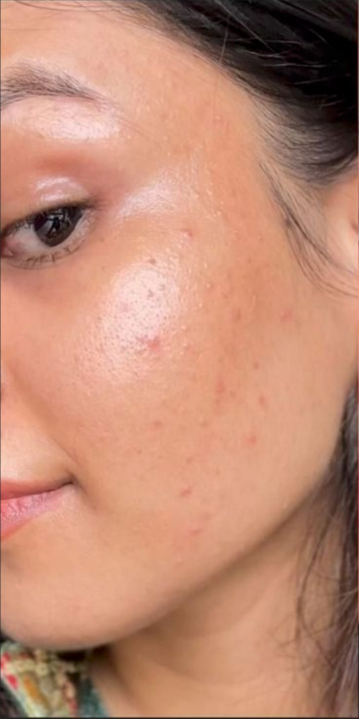 Skin showing signs of aging before using the Sungboon Complete Firming Care Trio