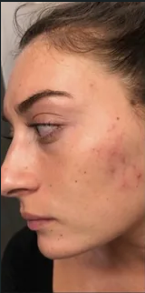 Visible pores and oily skin before treatment