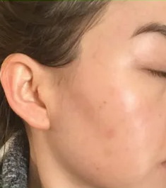 Smooth, firm skin post-treatment