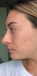 Radiant skin after using Exosome Shot