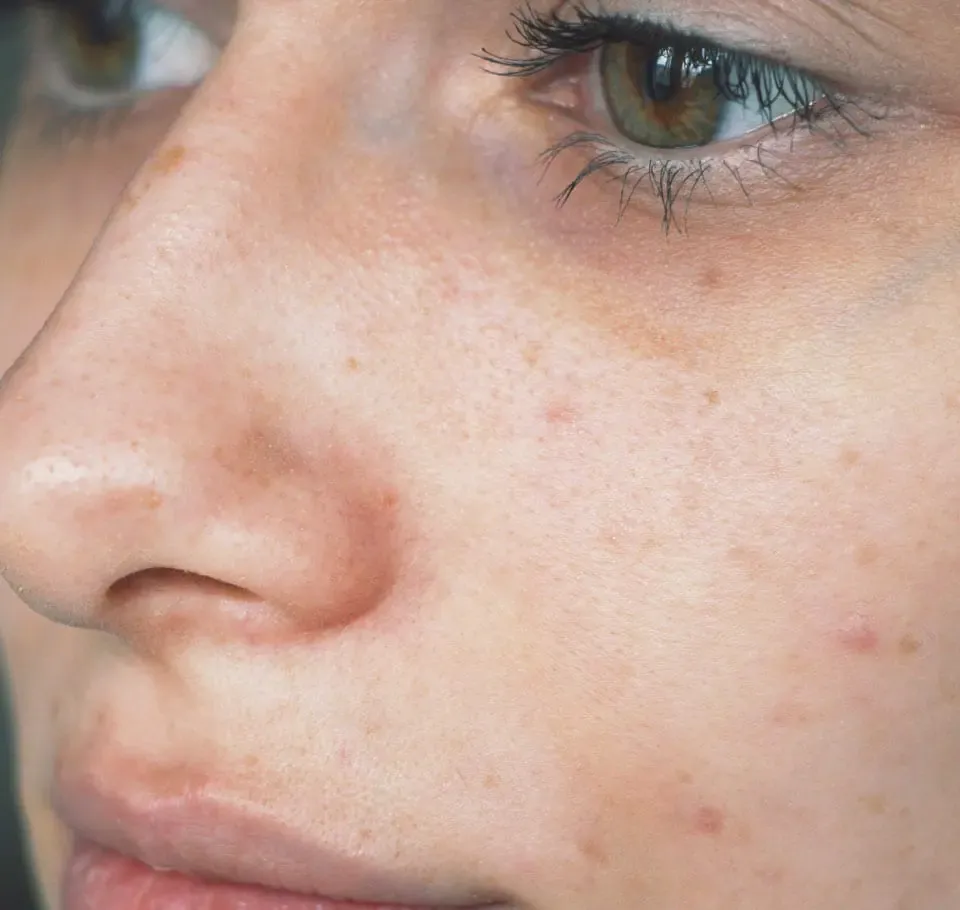 Image showing clear skin without blackheads