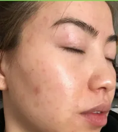Uneven texture and blackheads before using the bundle