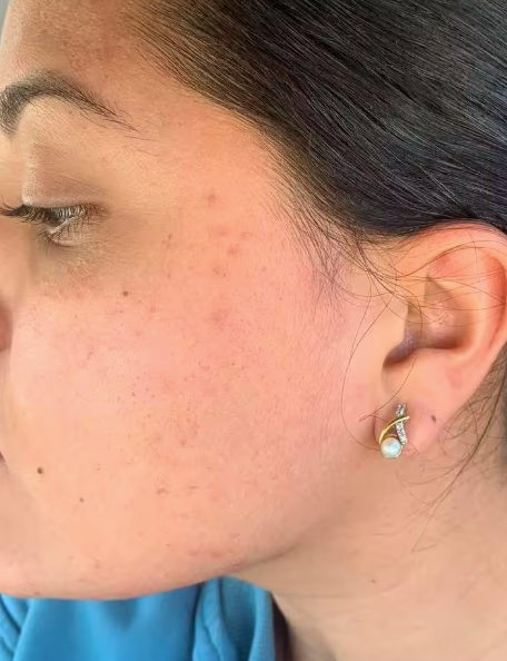Before and after comparison of skin improvement with ProductX