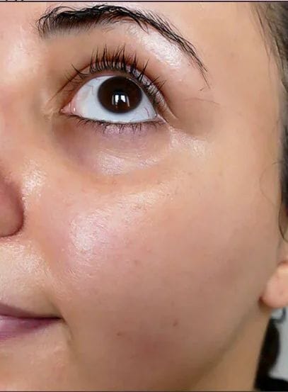 بشرة غير متجانسة قبل استخدام V-Soin