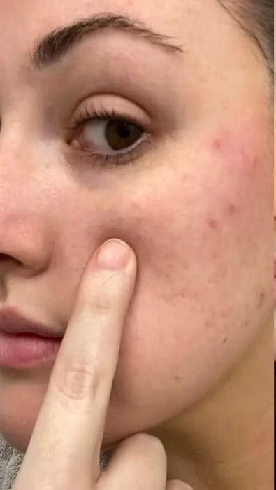 بشرة مع بقع داكنة قبل استخدام V-Soin