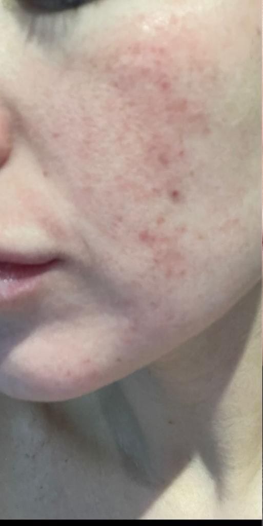 بشرة باهتة قبل استخدام V-Soin