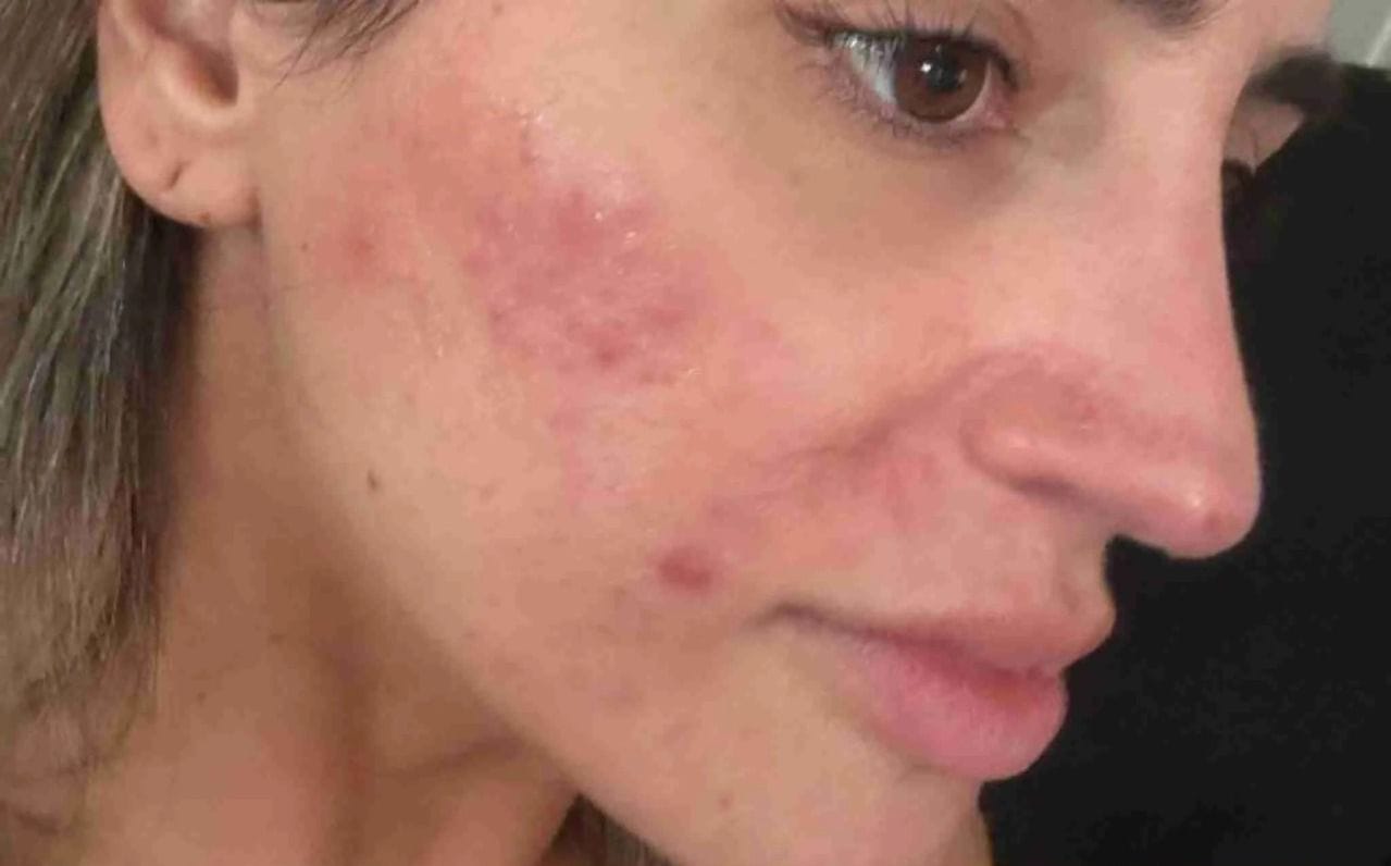 بشرة متعبة قبل استخدام V-Soin