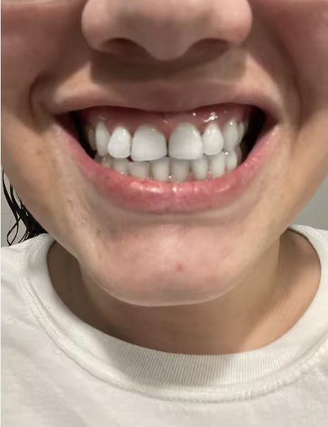 A dazzling, visibly brighter smile after using the purple toothpaste.