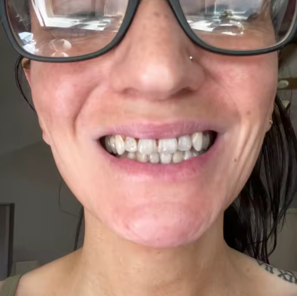 Close-up of teeth looking less yellow after brushing with purple paste.
