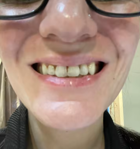 Person confidently smiling after daily use of purple toothpaste.