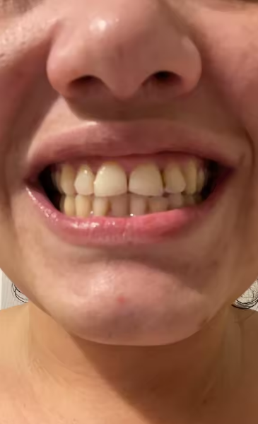 A smile with noticeable yellow tones before using the purple toothpaste.