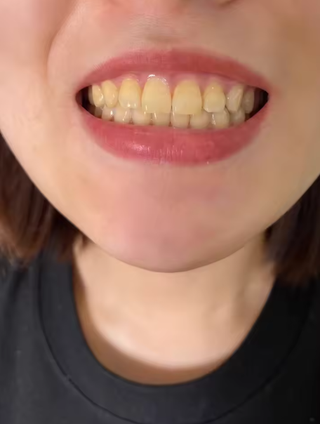 User applying purple color-correcting toothpaste to their brush.